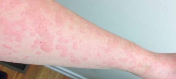 Ādas alerģijas liecina par parazītu klātbūtni organismā